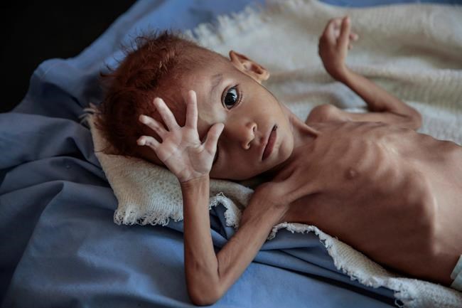 Aid group: 85,000 children may have died of hunger in Yemen | iNFOnews.ca Aid group: 85,000 children may have died of hunger in Yemen | iNFOnews.ca