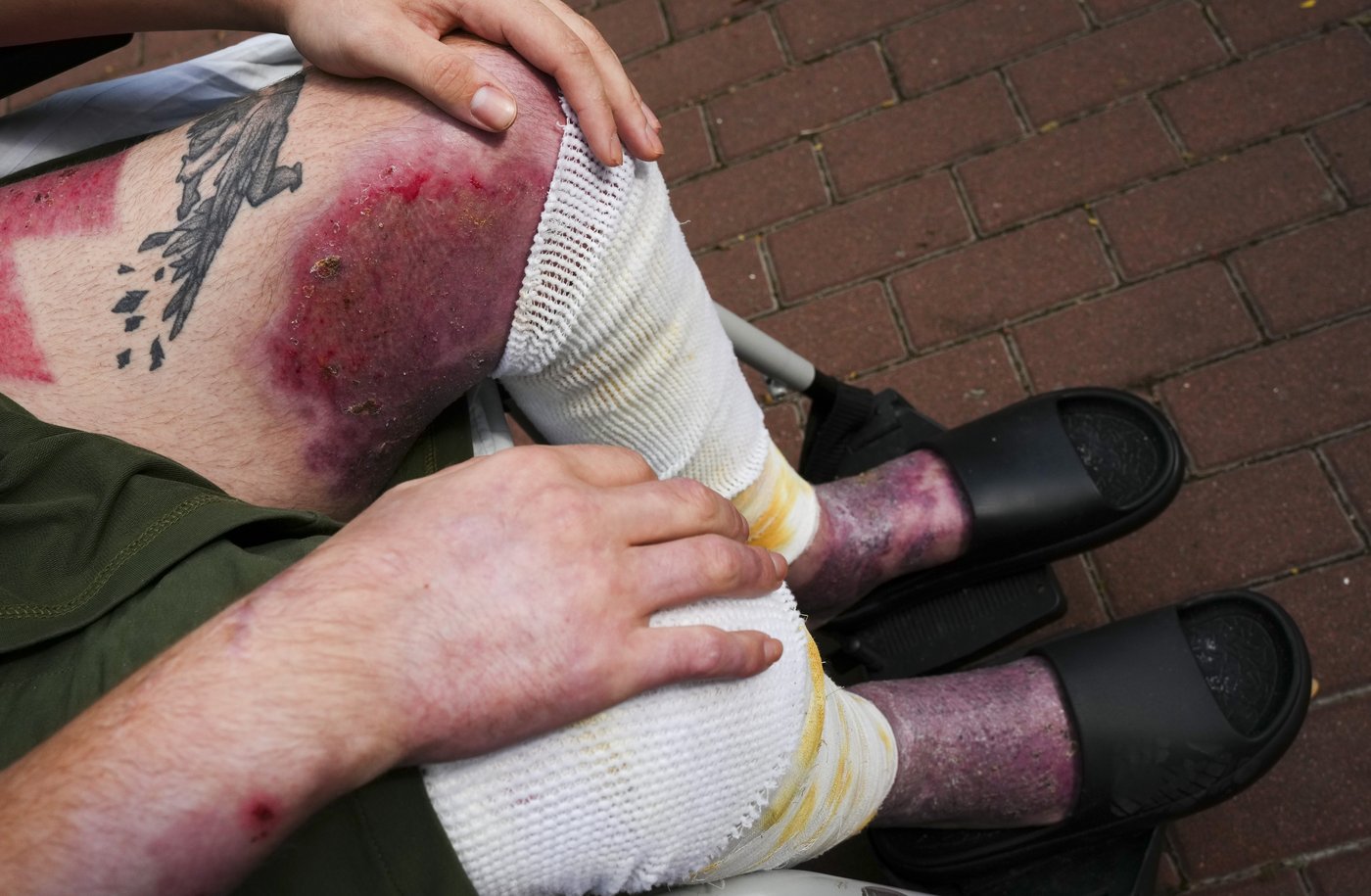 'Just shoot me': Calgarian fighting in Ukraine in painful recovery after drone attack | iNFOnews.ca