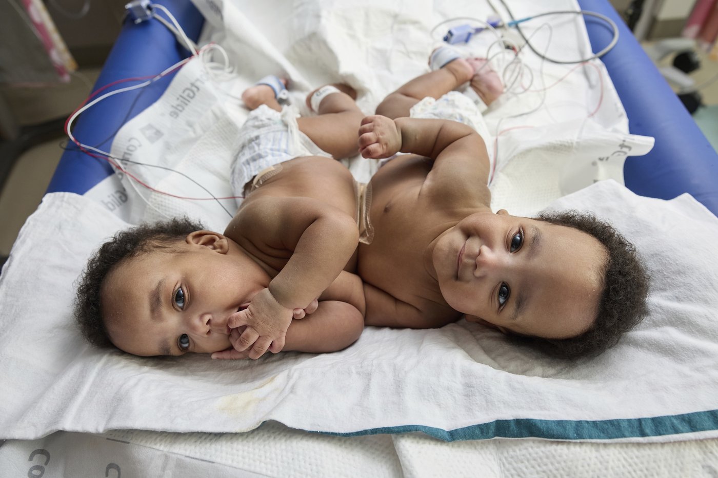 Twin boys born conjoined celebrate 1st birthday after separation surgery | iNFOnews.ca Twin boys born conjoined celebrate 1st birthday after separation surgery | iNFOnews.ca