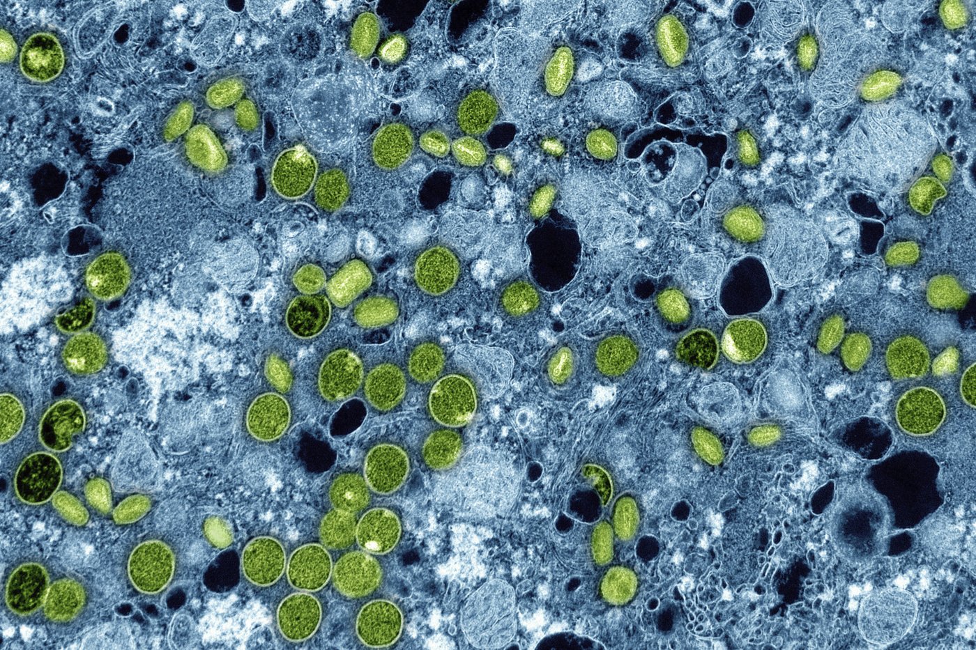 First Canadian case of more severe mpox strain confirmed in Manitoba | iNFOnews.ca First Canadian case of more severe mpox strain confirmed in Manitoba | iNFOnews.ca