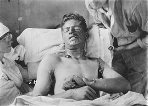 Unprecedented injuries from WWI spawned medical advances still used today | iNFOnews.ca CP29989418