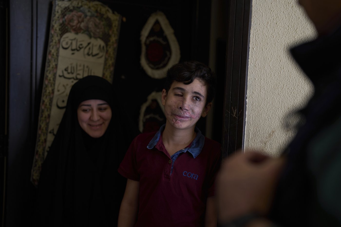 Survivors of Israel's pager attack on Hezbollah last year struggle to recover | iNFOnews.ca Survivors of Israel's pager attack on Hezbollah last year struggle to recover | iNFOnews.ca